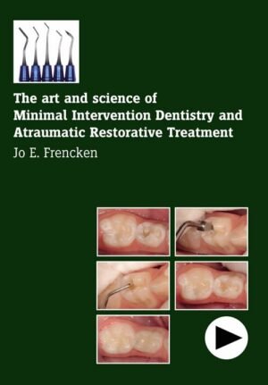 The art and science of Minimal Intervention Dentistry and Atraumatic